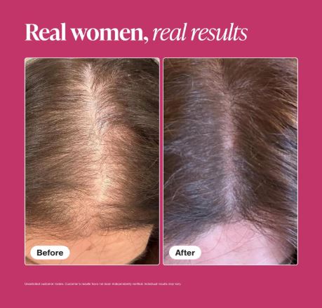 Viviscal Hair Growth Supplements for Women (180 Tablets) – Clinically Proven Hair Thinning Treatment for Thicker, Fuller & Stronger Hair (3 Month Supply)